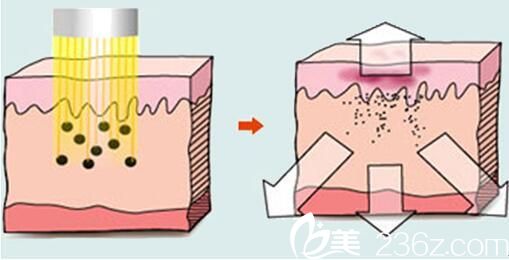 激光祛黄褐斑原理 激光祛黄褐斑原理