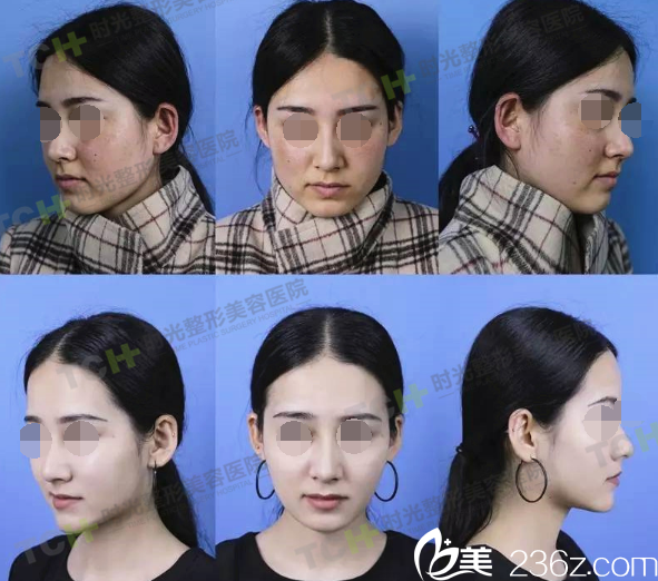 新疆女<!--<i data=20240703-sp></i>-->生时光祛斑治疗前后