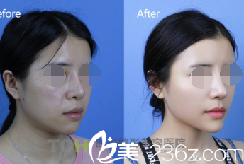 冯辉利整形案例 冯辉利整形案例