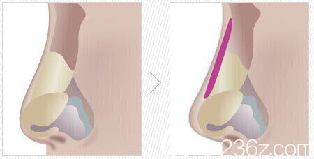 假体隆鼻放置位置