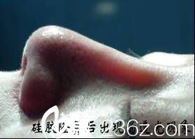 硅胶假体有透光的可能