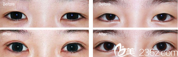 韩美双眼皮手术前后对比照片
