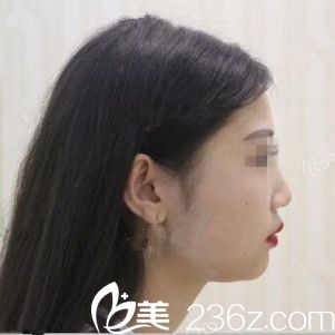 术前效果 术前效果