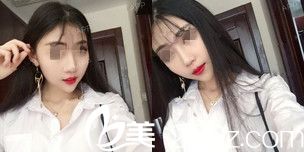 瘦脸17天后效果 瘦脸17天后效果