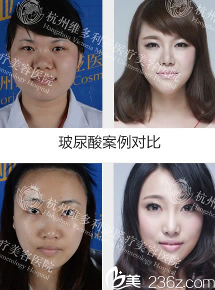 方叶琴医生注射玻尿酸案例图 方叶琴医生注射玻尿酸案例图