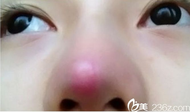 隆鼻硅胶穿出 隆鼻到底是膨体好还是硅胶好 隆鼻硅胶穿出 隆鼻到底是膨体好还是硅胶好