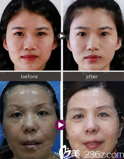 钟锋医生的祛斑美白案例