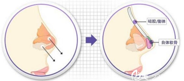 假体隆鼻 隆鼻到底是膨体好还是硅胶好 假体隆鼻 隆鼻到底是膨体好还是硅胶好