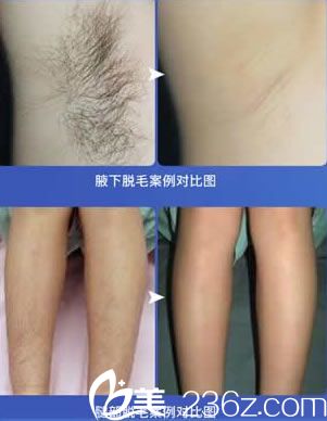 胡珊莺医生的脱毛案例图 胡珊莺医生的脱毛案例图