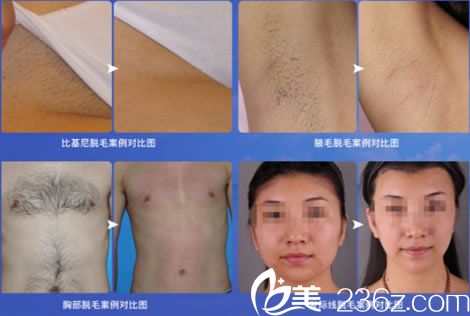 王婷婷医生的脱毛案例图 王婷婷医生的脱毛案例图