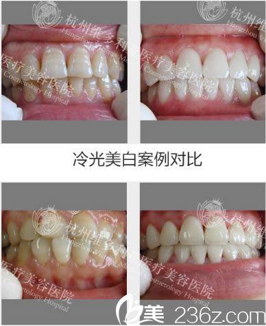 洪超医生做的牙齿美白<span style=