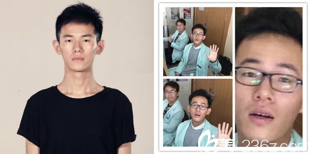 做全切双眼皮手术前的照片 做全切双眼皮手术前的照片