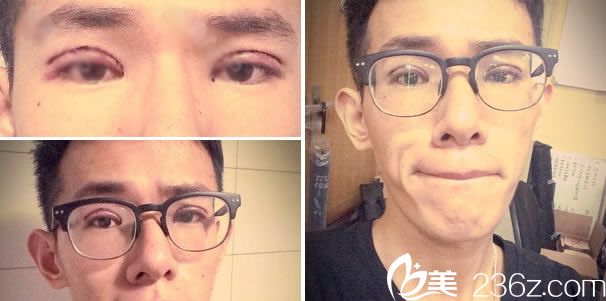 双眼皮手术当天的效果图 双眼皮手术当天的效果图