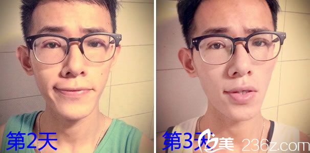 全切双眼皮去皮脂手术第3天 全切双眼皮去皮脂手术第3天