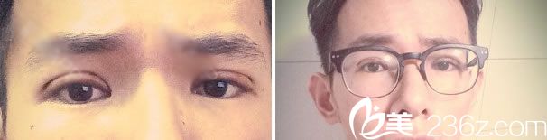 做双眼皮手术第5天效果 做双眼皮手术第5天效果