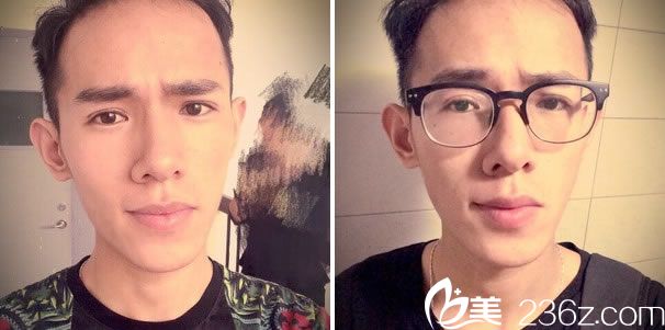 全切双眼皮手术第10天的效果 全切双眼皮手术第10天的效果