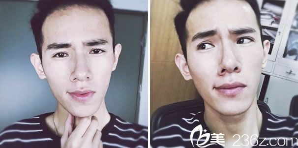 全切双眼皮去皮脂手术50天效果 全切双眼皮去皮脂手术50天效果