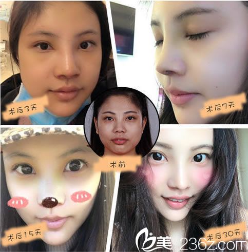 维多利亚隆鼻真人案例图 维多利亚隆鼻真人案例图