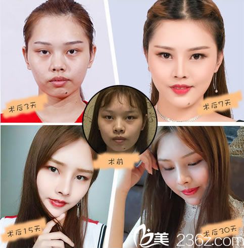 假体隆鼻手术30天的效果图 假体隆鼻手术30天的效果图