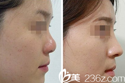 陈玉连隆鼻整形案例 陈玉连隆鼻整形案例