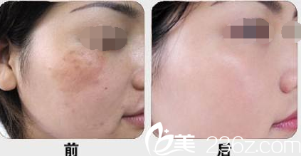 林丽蓉医生皮肤整形案例 林丽蓉医生皮肤整形案例