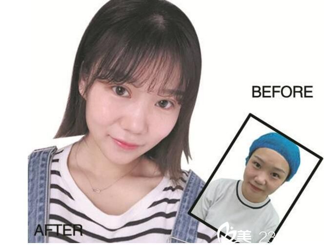 易院玲 双眼皮手术对比图