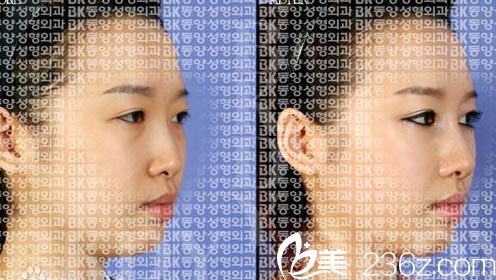 鼻子整形案例 鼻子整形案例