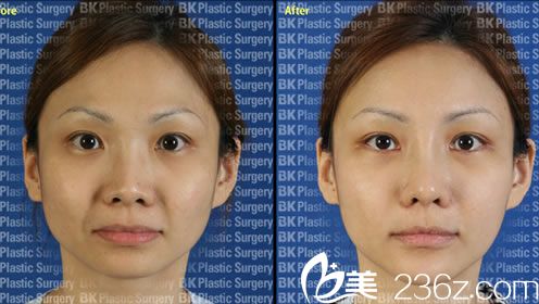 面部轮廓整形案例 面部轮廓整形案例