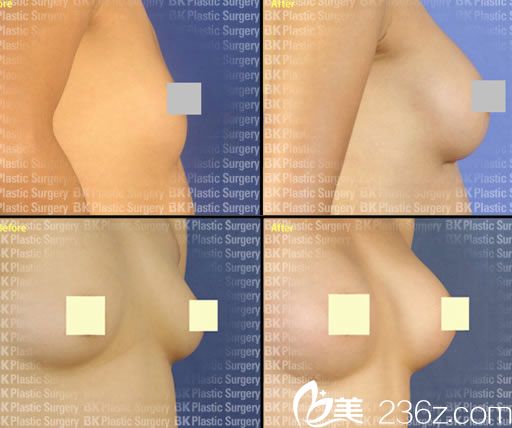 琴仁燮院长的胸部整形案例