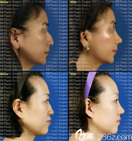 高殷锡院长的鹰钩鼻矫正案例