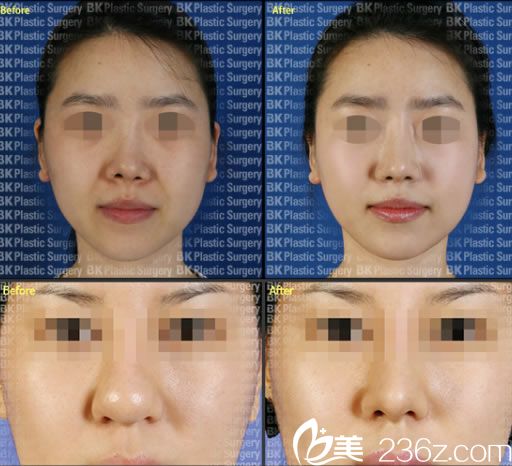 高殷锡院长鼻修复案例