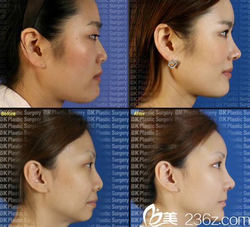 高殷锡院长隆鼻手术案例