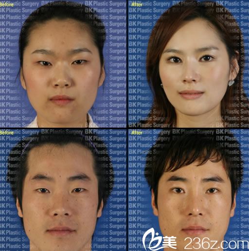 都彦禄院长的切开法双眼皮案例 都彦禄院长的切开法双眼皮案例