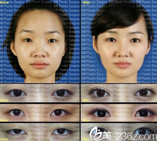 埋线法双眼皮案例 埋线法双眼皮案例