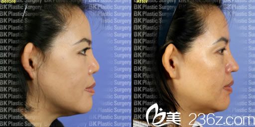 姜相求院长短鼻矫正案例 姜相求院长短鼻矫正案例