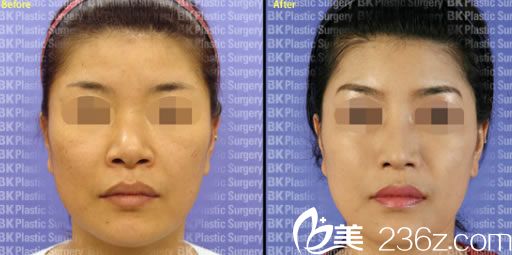 姜相求院长假体隆鼻案例 姜相求院长假体隆鼻案例