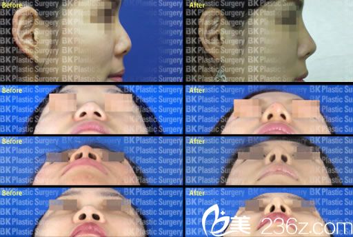 李丙濬院长的鼻整形案例