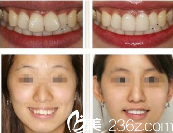 太原时光白丽鹏医生牙齿正畸真人案例 太原时光白丽鹏医生牙齿正畸真人案例