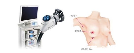聚星医院隆胸手术的医生金光善医生采用的内窥镜仪器