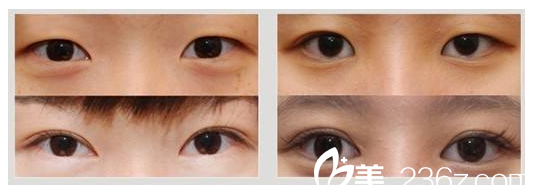 彭利涛眼部整形案例 彭利涛眼部整形案例
