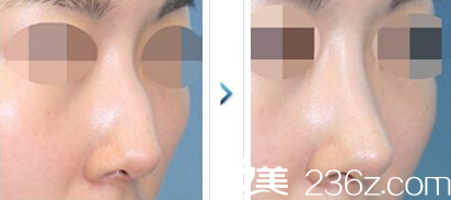 彭利涛鼻部整形案例 彭利涛鼻部整形案例