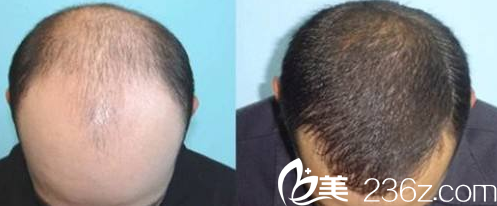 杨杰毛发移植整形案例