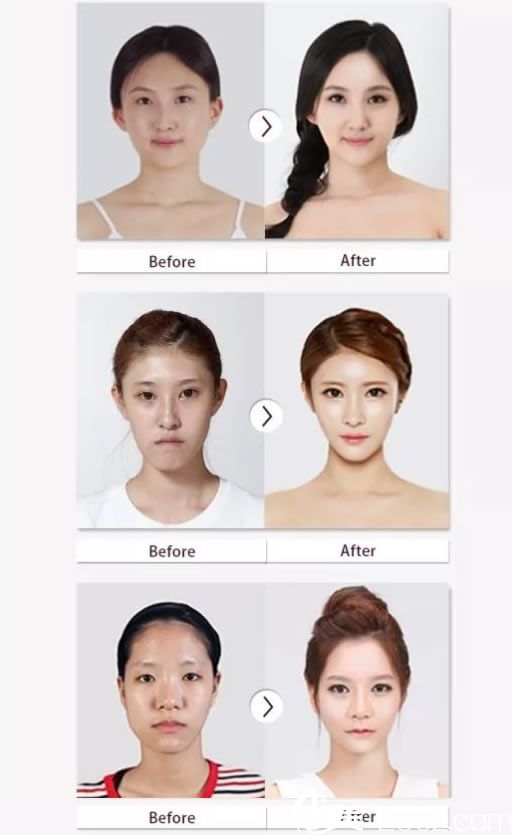 韩国BK整形案例效果图