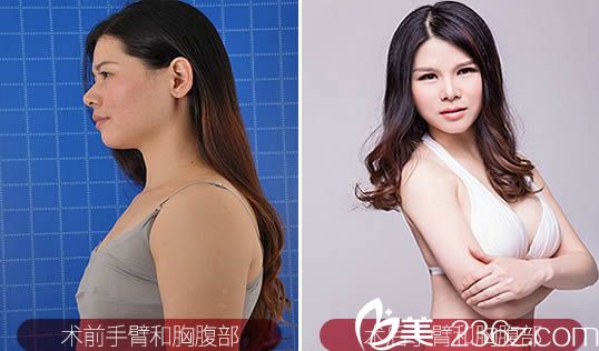 刘耀美自体脂肪丰胸及塑形案例