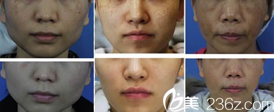 林秋蓉医生激光祛斑案例 林秋蓉医生激光祛斑案例