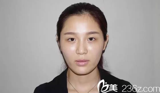 自从找福州比华利林平院长做双眼皮+开眼角后让我变电眼