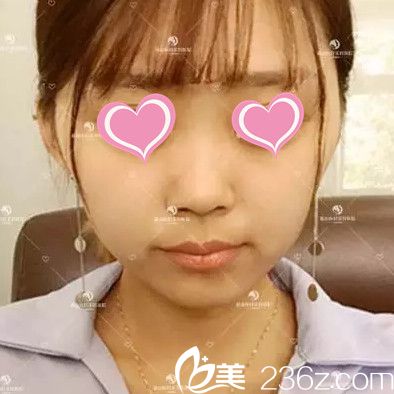 术前短下巴的我 术前短下巴的我