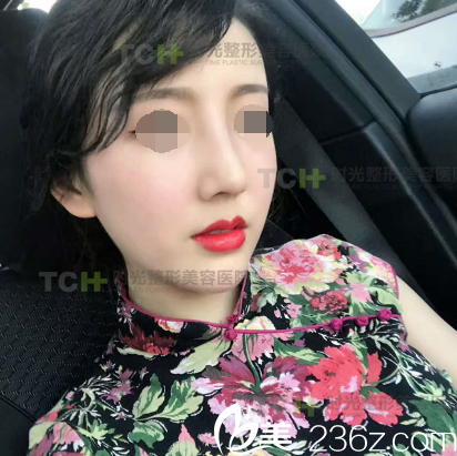 在重庆时光做DBM生态美弧隆鼻术后15天 在重庆时光做DBM生态美弧隆鼻术后15天