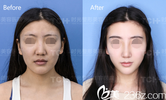 重庆时光DBM生态美弧鼻对比图 重庆时光DBM生态美弧鼻对比图