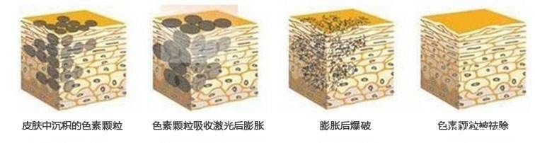 激光祛斑原理 激光祛斑原理
